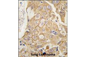 Formalin-fixed and paraffin-embedded human lung carcinoma tissue reacted with ADCY2 antibody , which was peroxidase-conjugated to the secondary antibody, followed by DAB staining. (ADCY2 Antikörper  (C-Term))
