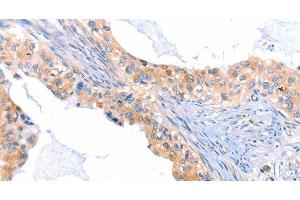Immunohistochemistry of paraffin-embedded Human cervical cancer tissue using THBS1 Polyclonal Antibody at dilution 1:60 (Thrombospondin 1 Antikörper)