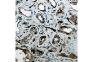 Immunohistochemical analysis of Aquaporin 4 staining in human lung cancer formalin fixed paraffin embedded tissue section. (Aquaporin 4 Antikörper  (Center))