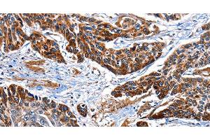 Immunohistochemistry of paraffin-embedded Human esophagus cancer tissue using ITGA7 Polyclonal Antibody at dilution 1:35 (ITGA7 Antikörper)