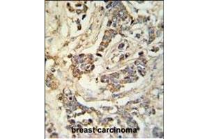 MR Antibody (N-term) 9980a IHC analysis in formalin fixed and paraffin embedded breast carcinoma followed by peroxidase conjugation of the secondary antibody and DAB staining. (MRAP Antikörper  (N-Term))