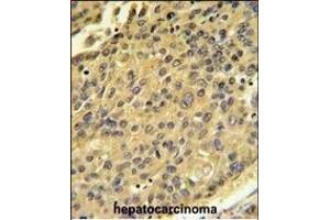 CTSH Antibody (N-term) (ABIN391569 and ABIN2841506) IHC analysis in formalin fixed and paraffin embedded human hepatocarcinoma followed by peroxidase conjugation of the secondary antibody and DAB staining. (Cathepsin H Antikörper  (N-Term))