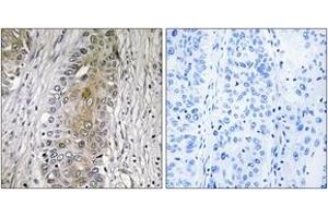 Immunohistochemistry analysis of paraffin-embedded human lung carcinoma, using SAA4 Antibody.