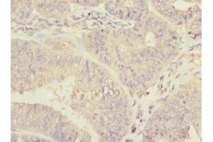Immunohistochemistry of paraffin-embedded human endometrial cancer using ABIN7150598 at dilution of 1:100 (Ribophorin II Antikörper  (AA 360-540))