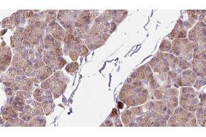 ABIN6273262 at 1/100 staining Human pancreas cancer tissue by IHC-P. (DHX58 Antikörper  (Internal Region))