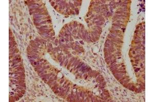 Immunohistochemical of paraffin-embedded human ovarian cancer using ABIN7153439 at dilution of 1:100 (Galectin 3 Antikörper)