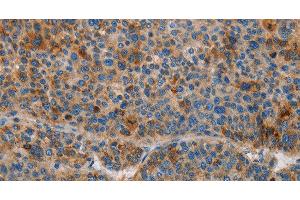 Immunohistochemistry of paraffin-embedded Human liver cancer using AMBP Polyclonal Antibody at dilution of 1:55 (AMBP Antikörper)