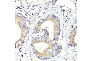 Immunohistochemistry of paraffin-embedded human colon carcinoma using HB-EGF antibody (ABIN7267617) at dilution of 1:100 (40x lens). (HBEGF Antikörper  (AA 20-160))