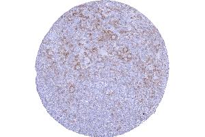 Lymph node Hodgkins lymphoma with distinct TIGIT positivity of a subset of non neoplastic lymphocytes surrounding tumor cells