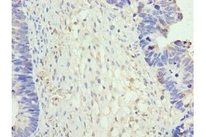 Immunohistochemistry of paraffin-embedded human ovarian cancer using ABIN7161852 at dilution of 1:100 (NR2C2AP Antikörper  (AA 7-139))