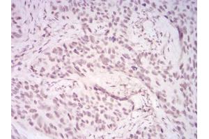 Immunohistochemical analysis of paraffin-embedded cervical cancer tissues using DDX39B mouse mAb with DAB staining. (DDX39B Antikörper  (AA 1-250))