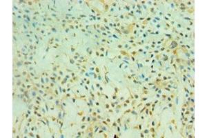 Immunohistochemistry of paraffin-embedded human breast cancer using ABIN7160859 at dilution of 1:100 (SIRT3 Antikörper  (AA 20-130))