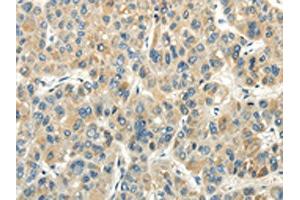 The image on the left is immunohistochemistry of paraffin-embedded Human liver cancer tissue using ABIN7190243(CHGB Antibody) at dilution 1/30, on the right is treated with synthetic peptide. (CHGB Antikörper)
