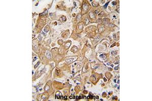 Formalin-fixed and paraffin-embedded human lung carcinomareacted with LECT1 polyclonal antibody , which was peroxidase-conjugated to the secondary antibody, followed by AEC staining. (LECT1 Antikörper  (C-Term))