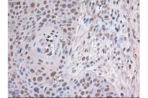 Immunohistochemical staining of paraffin-embedded Adenocarcinoma of breast using anti-Trim33 (ABIN2452534) mouse monoclonal antibody (TRIM33 Antikörper  (AA 887-1046))