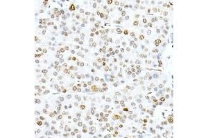 Immunohistochemistry of paraffin-embedded human liver cancer using Phospho-Histone H3. (Histone H3.3 Antikörper  (pSer31))