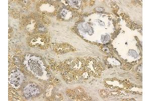 MGAT5 Mouse Monoclonal Antibody at 1/100 staining human ovarian cancer by IHC-P.