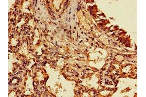 Immunohistochemistry of paraffin-embedded human lung cancer using ABIN7153207 at dilution of 1:100 (TIGAR Antikörper  (AA 24-188))
