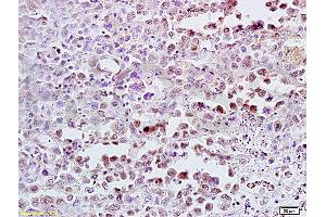 Formalin-fixed and paraffin embedded mouse lymphoma tissue labeled with Anti-CDK4 Polyclonal Antibody (ABIN671166), Unconjugated at 1:300, followed by conjugation to the secondary antibody and DAB staining