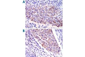 Immunohistochemical analysis of paraffin-embedded human cervical cancer tissues (A) and human kidney cancer tissues (B) using MMP1 monoclonal antibody, clone 6A5  with DAB staining.