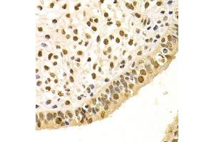 Immunohistochemistry of paraffin-embedded human uterine cancer using DDB1 Antibody. (DDB1 Antikörper)