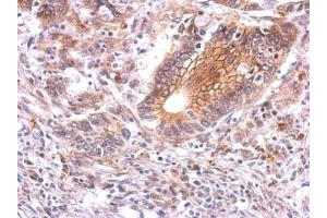IHC-P Image beta Catenin antibody detects CTNNB1 protein at membrane on human gastric cancer by immunohistochemical analysis. (CTNNB1 Antikörper)