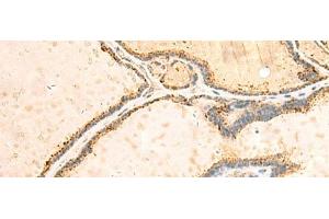 Immunohistochemistry of paraffin-embedded Human thyroid cancer tissue using IGFBPL1 Polyclonal Antibody at dilution of 1:55(x200)