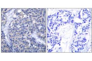 Immunohistochemical analysis of paraffin-embedded human breast carcinoma tissue, using Zap-70 (Ab-319) antibody (E021173). (ZAP70 Antikörper)