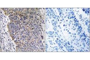 Immunohistochemistry analysis of paraffin-embedded human lung carcinoma tissue, using MGST3 Antibody.