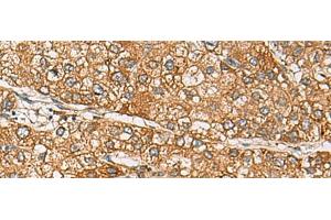 Immunohistochemistry of paraffin-embedded Human liver cancer tissue using DCAF12 Polyclonal Antibody at dilution of 1:65(x200) (DCAF12 Antikörper)