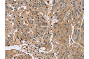 The image on the left is immunohistochemistry of paraffin-embedded Human breast cancer tissue using ABIN7191184(KCNJ15 Antibody) at dilution 1/35, on the right is treated with synthetic peptide. (KCNJ15 Antikörper)