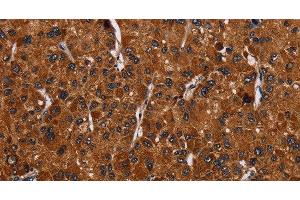 Immunohistochemistry of paraffin-embedded Human liver cancer tissue using RTN4R Polyclonal Antibody at dilution 1:50 (RTN4R Antikörper)