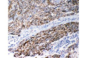 Anti-Stefin B antibody, IHC(P) IHC(P): Human Lung Cancer Tissue (CSTB Antikörper  (Middle Region))