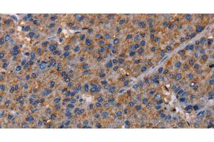 Immunohistochemistry of paraffin-embedded Human liver cancer using NUP62 Polyclonal Antibody at dilution of 1:40 (NUP62 Antikörper)