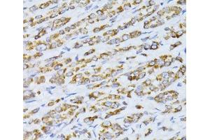 Immunohistochemistry of paraffin-embedded Human colon carcinoma using CCDC92 Polyclonal Antibody at dilution of 1:100 (40x lens). (CCDC92 Antikörper)
