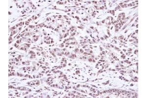 IHC-P Image Immunohistochemical analysis of paraffin-embedded A549 Xenograft, using SMC1A, antibody at 1:100 dilution. (SMC1A Antikörper  (N-Term))