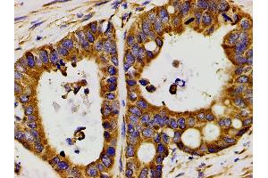 ABIN6267452 at 1/200 staining human colon cancer tissue sections by IHC-P.