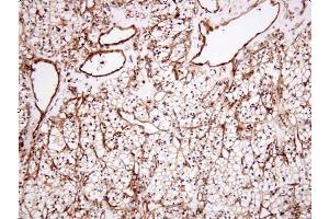 Paraffin embedded sections of human renal cell carcinoma tissue were initrocelluloseubated with anti-human Clusterin (1:100) for 2 hours at room temperature. (Clusterin Antikörper  (AA 1-333))