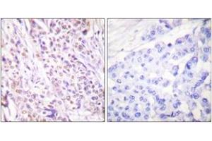 Immunohistochemistry analysis of paraffin-embedded human breast carcinoma tissue, using RAD17 (Ab-645) Antibody.