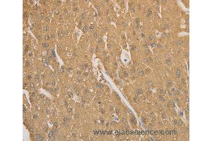 Immunohistochemistry of Human gastric cancer using CD40 Polyclonal Antibody at dilution of 1:70 (CD40 Antikörper)