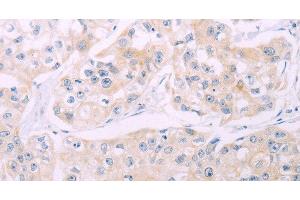 Immunohistochemistry of paraffin-embedded Human breast cancer tissue using ADCY7 Polyclonal Antibody at dilution 1:60 (ADCY7 Antikörper)