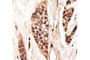 IHC analysis of FFPE human breast carcinoma tissue stained with the TAP1 antibody (TAP1 Antikörper  (AA 765-794))