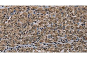 Immunohistochemistry of paraffin-embedded Human thyroid cancer tissue using NLRP6 Polyclonal Antibody at dilution 1:50 (NLRP6 Antikörper)