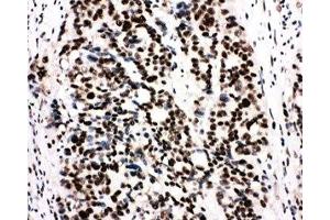 IHC-P: Ku80 antibody testing of human breast cancer tissue