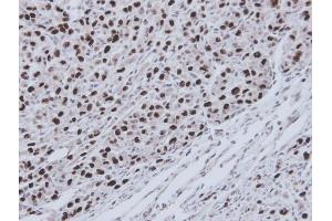 IHC-P Image Immunohistochemical analysis of paraffin-embedded U87 xenograft, using RecQ1, antibody at 1:100 dilution. (RecQ Protein-Like (DNA Helicase Q1-Like) (RECQL) (C-Term) Antikörper)