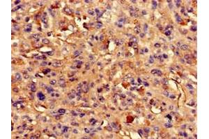 Immunohistochemistry of paraffin-embedded human melanoma using ABIN7144568 at dilution of 1:100 (ARAP3 Antikörper  (AA 163-320))