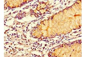 Immunohistochemistry of paraffin-embedded human colon cancer using ABIN7170420 at dilution of 1:100 (SMOC1 Antikörper  (AA 277-382))