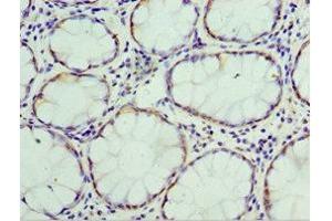 Immunohistochemistry of paraffin-embedded human colon cancer using ABIN7172096 at dilution of 1:100 (THBS3 Antikörper  (AA 787-956))