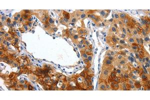 Immunohistochemistry of paraffin-embedded Human lung cancer using Placental Alkaline Phosphatase Polyclonal Antibody at dilution of 1:50 (PLAP Antikörper)