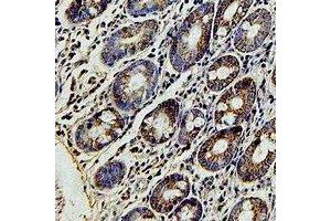 Immunohistochemical analysis of FBL5 staining in human colon cancer formalin fixed paraffin embedded tissue section. (FBXL4 Antikörper)